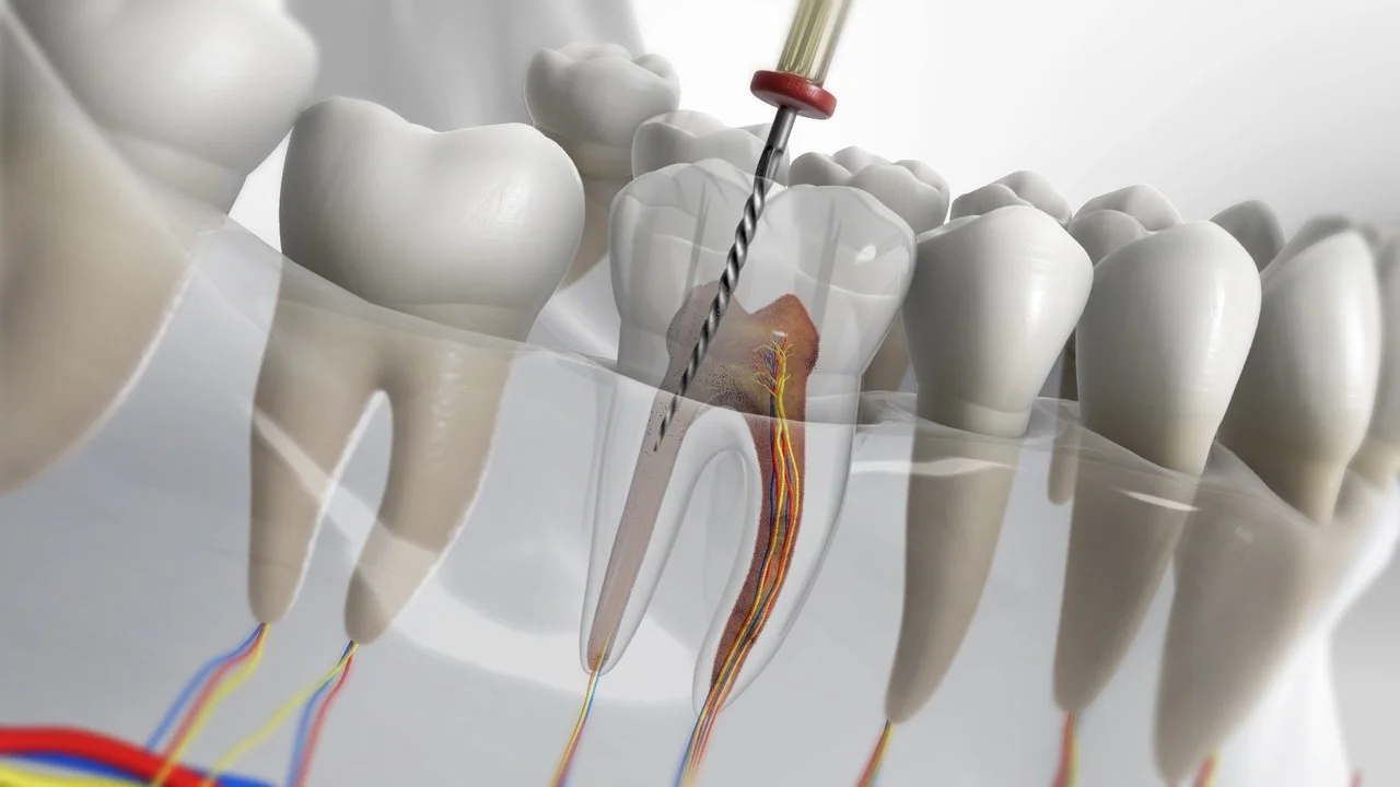 Root Canal Treatment dubai