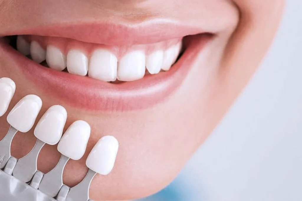 What Are the Advantages of Veneers for Smile Enhancement? 1 Veneers