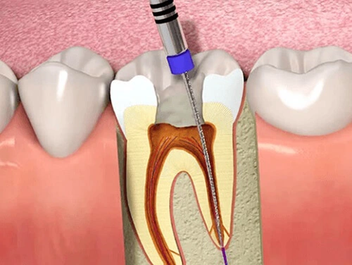 How Can a Root Canal Treatment Save Your Tooth? 2 root canal cost in Dubai