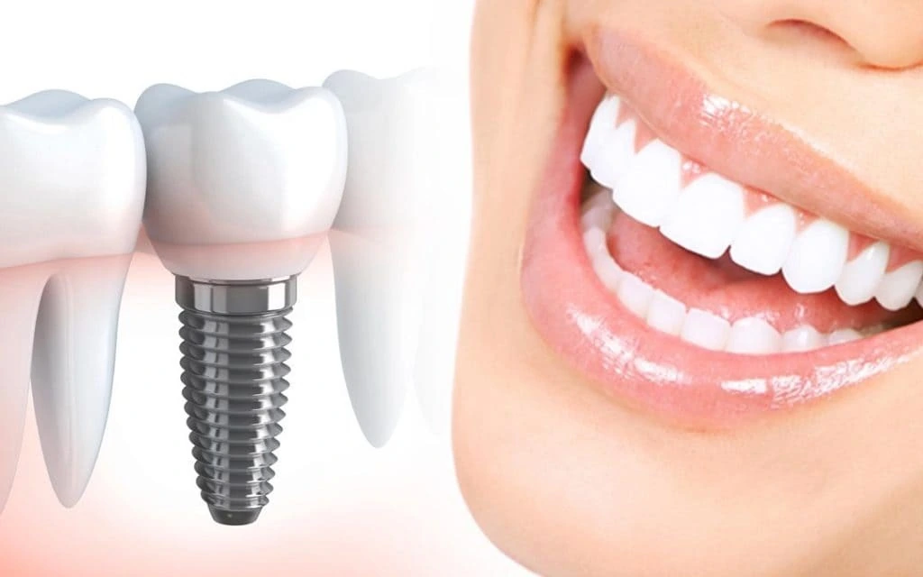 Cheapest Dental Implants in Dubai
