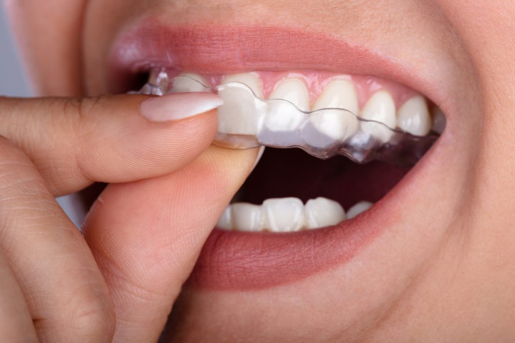 Clear Aligner in Dubai