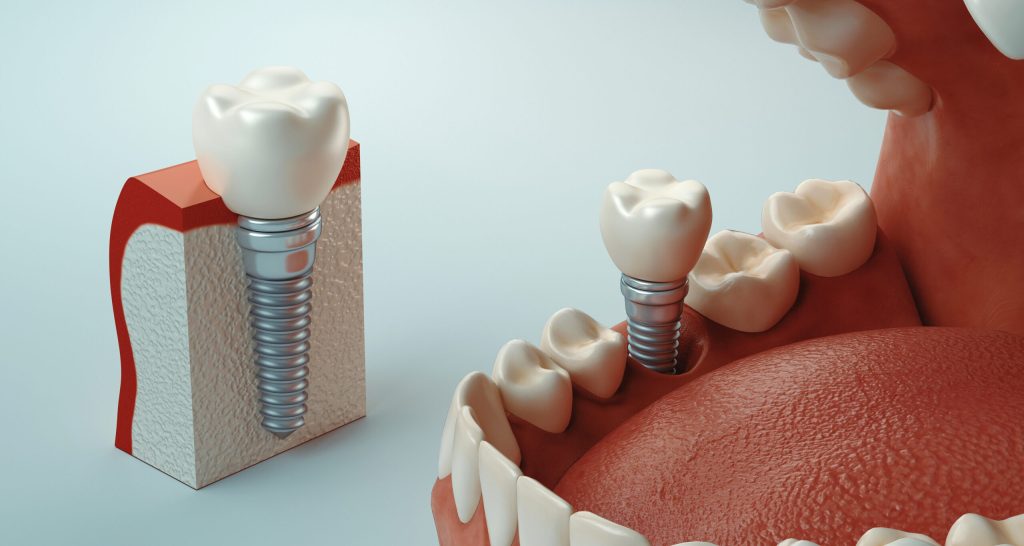 Dental Implants Treatment Dubai