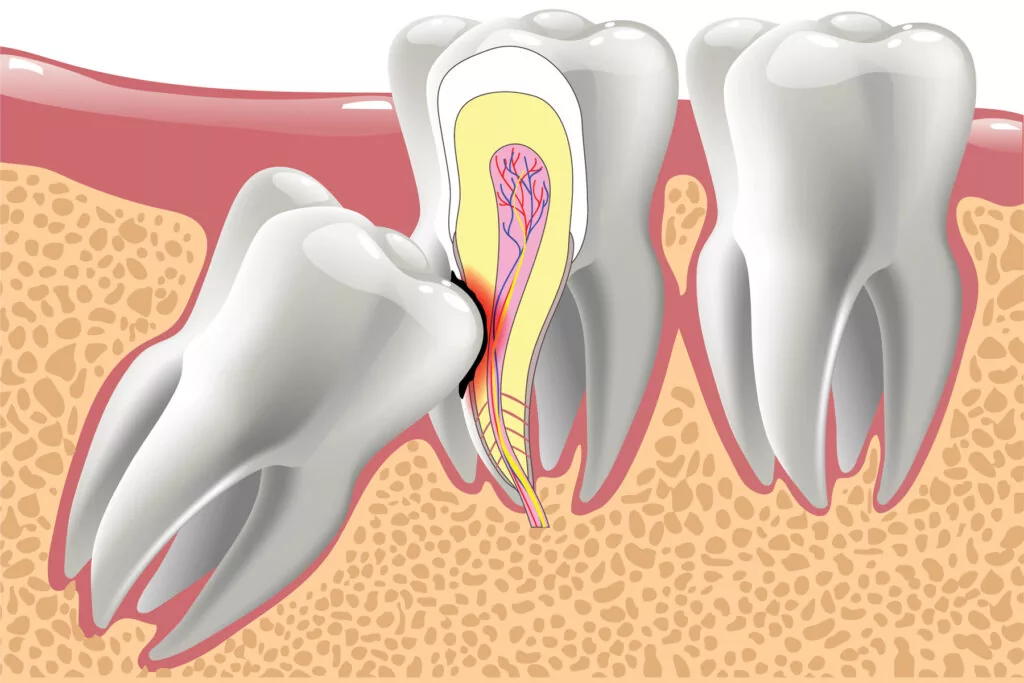 Top 12 Teeth Problems and Solutions 4 Dental Clinic Dubai
