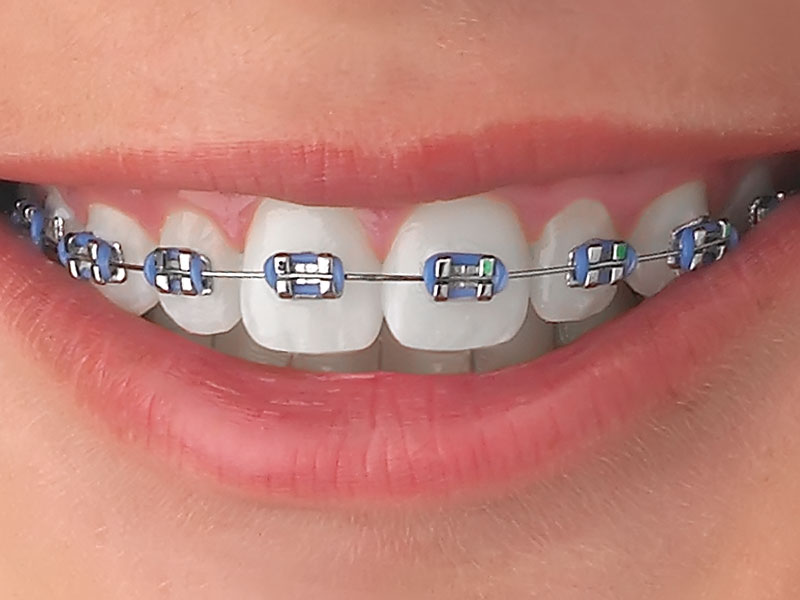 How Orthodontic Braces Can Change Your Face Appearance? 3 Orthodontic Braces 1