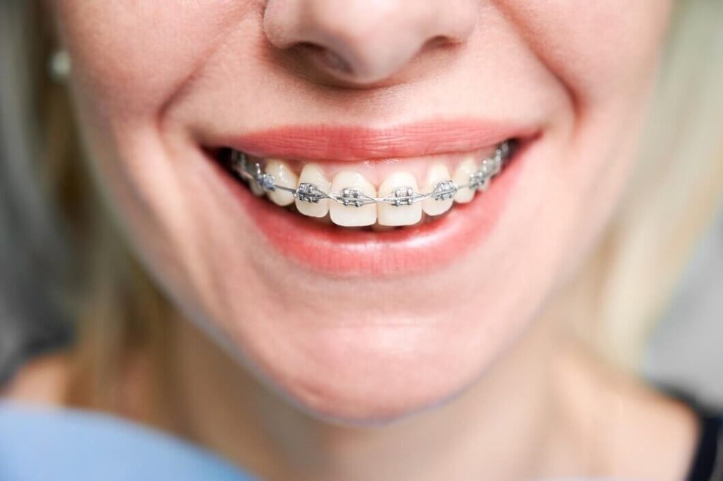 How Orthodontic Braces Can Change Your Face Appearance? 4 Orthodontic Braces