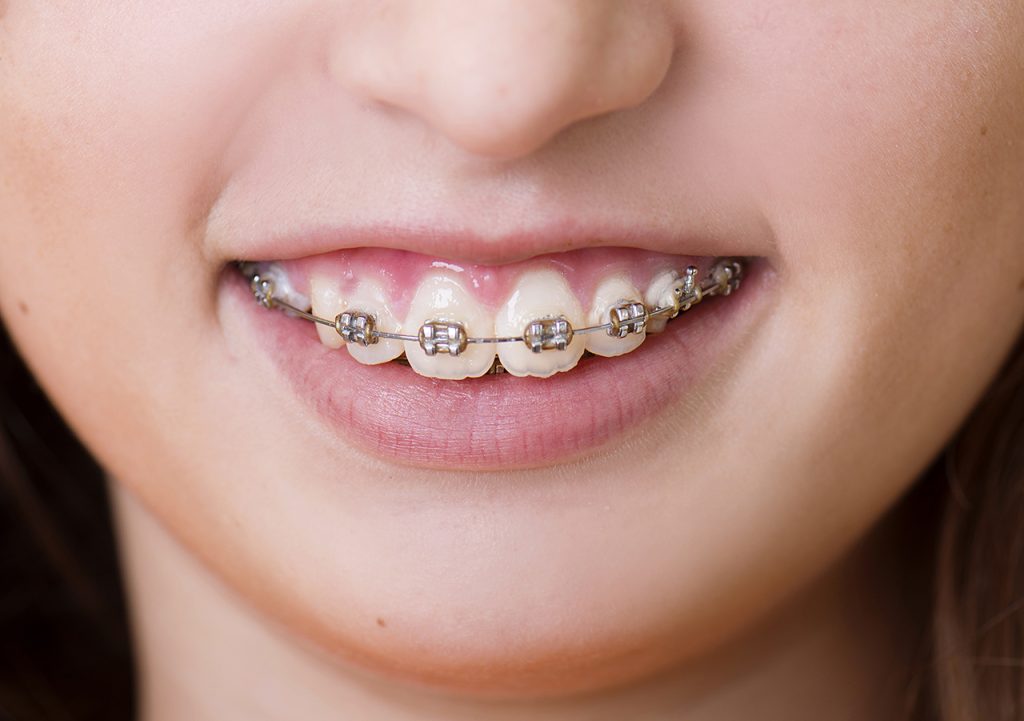 How Orthodontic Braces Can Change Your Face Appearance? 4 Orthodontic Braces 2