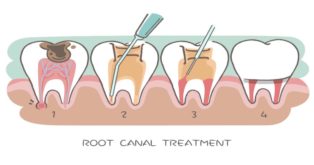 Root Canal Aftercare: Steps for Ensuring Long-Term Oral Health 3 root canal treatment dubai