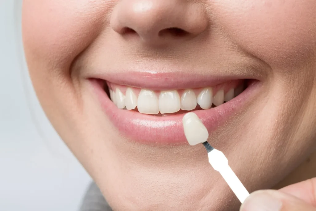 What Determines Your Veneer Cost in Dubai Conventions? 2 Veneer Cost