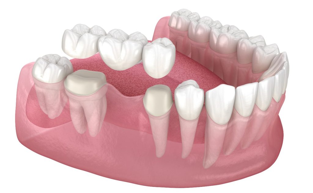 When Should You Choose Crowns and Bridges Treatment? 2 cosmetic dentistry