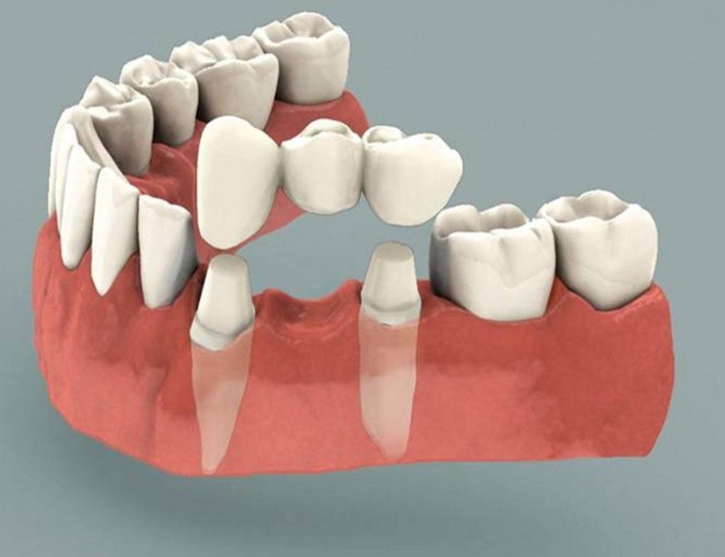 Crowns and Bridges in Dubai: When Do You Actually Need One? 2 Cosmetic dentistry