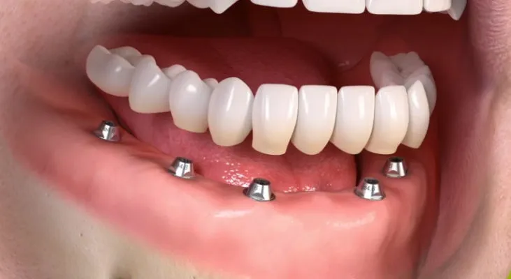 Dental implant cost in Dubai: Single Tooth vs Full Mouth Breakdown 2 Dental Implant Dubai Price