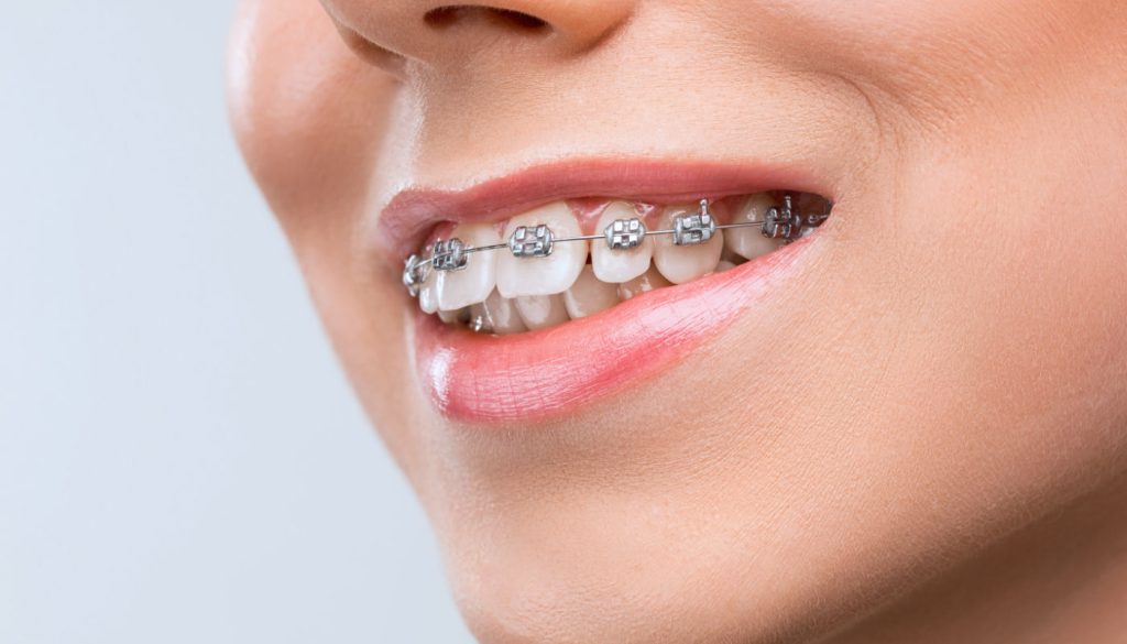 Orthodontic Treatment in Dubai: At What Age Should You Start? 2 Orthodontist dubai