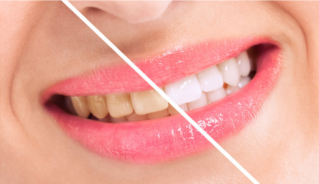 Teeth Cleaning and Whitening Cost Near Me: What Dubai Patients Pay in 2026 2 Teeth cleaning and whitening cost near me