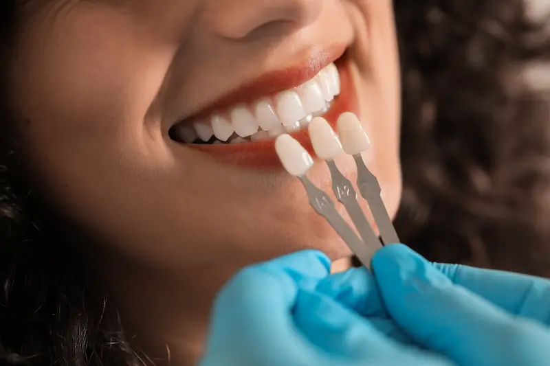 Veneers Dubai Price: Composite vs Porcelain, What Are You Paying For? 2 Veneers cost dubai