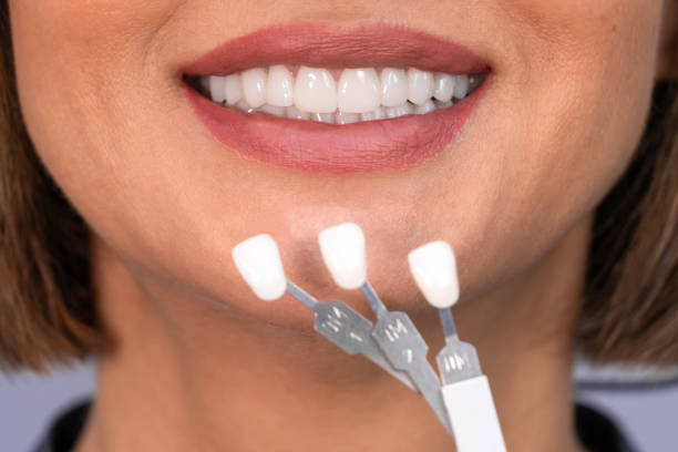 Veneers Dubai Price: Composite vs Porcelain, What Are You Paying For? 1 Veneers dubai price