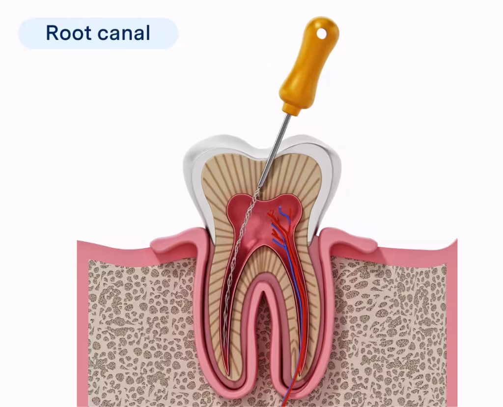 What Is Root Canal Treatment in Dubai and When Do You Need It? 2 root cannanl